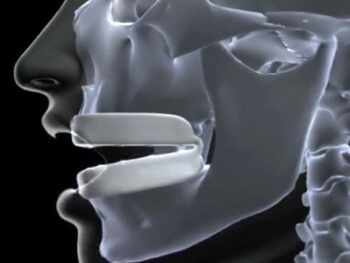 comfortable mouth guard