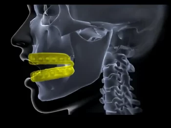 sports mouth guard for orthodontic braces
