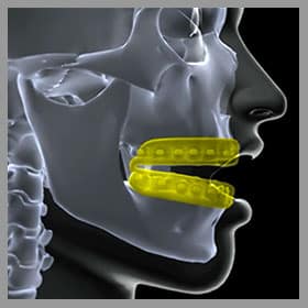 How Does a Mouth Guard Protect Your Teeth? - Sonoran Desert