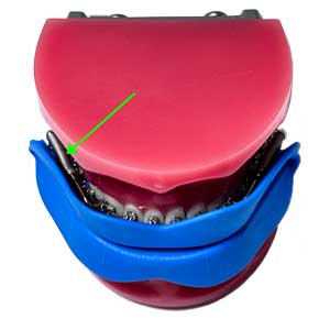 forsus braces mouth guard