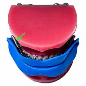 forsus sports mouthguard