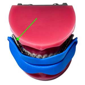 herbst braces mouth guard