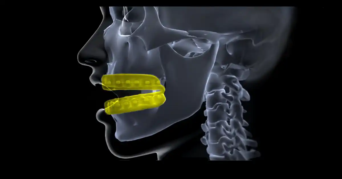 sports mouth guard for orthodontic braces