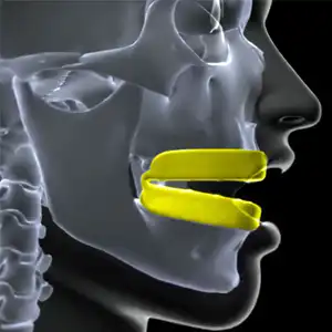 double sports mouthguard