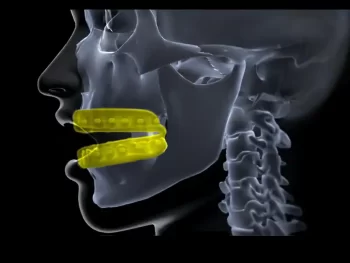 sports mouth guard for orthodontic braces